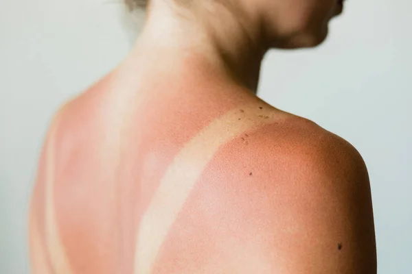 Close Sunburn Marks Woman Back — Stock Photo, Image