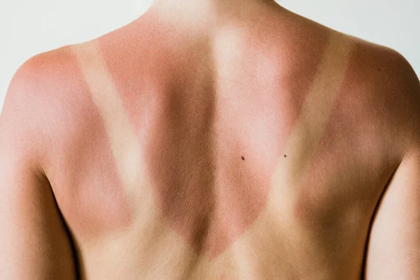 Close Sunburn Marks Woman Back — Stock Photo, Image