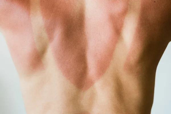 Kadının sırtında güneş yanığı izleri var.