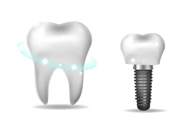 Diş implantları, protez 3 boyutlu gerçekçi stil. Dişçilik, sağlıklı diş konsepti. Vektör illüstrasyonu — Stok Vektör