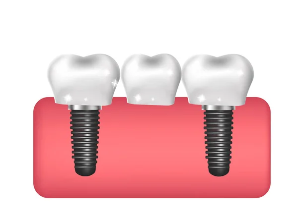 Diş implantları, köprü inşaatı, protez 3D gerçekçi stil. Dişçilik, sağlıklı diş konsepti. Vektör illüstrasyonu — Stok Vektör