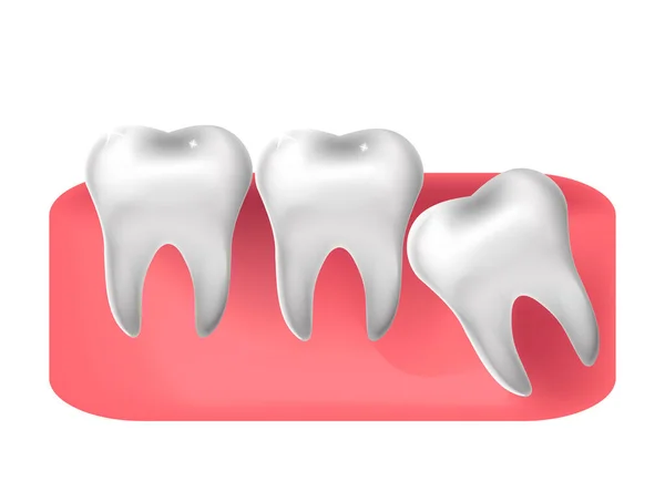 Yirmilik diş kesimi, 3 boyutlu gerçekçi stil. Diş hekimliği, yirmilik diş çıkarma konsepti. Vektör illüstrasyonu — Stok Vektör