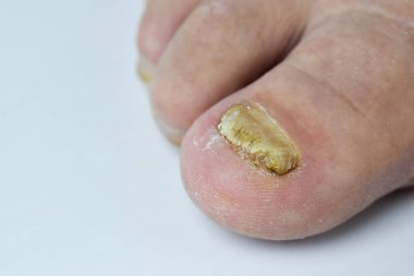 Fungus on toenails close up clipart