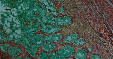 Bardak hücreleri salgılayarak bağırsağın divertikülozu