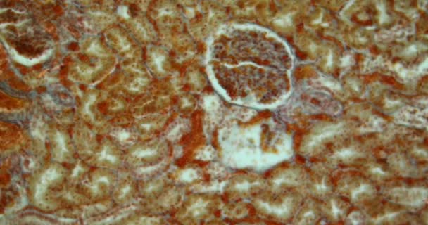 Žloutenka Žloutence Důsledku Infekce Hepatitidou Pod Mikroskopem — Stock video