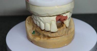 Üst çenesinde implantlar olan alçıdan yapılmış takma diş izi