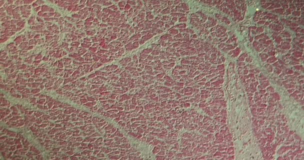 Infarctus Myocarde Maladie Tissu Musculaire Cardiaque Amplifié 100X Microscope — Video