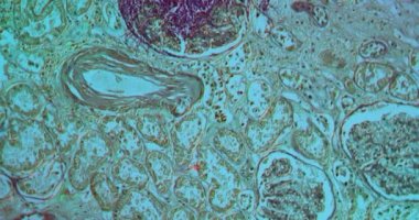 Candida mantar enfeksiyonlu AIDS hastalarında mikroskop altında böbrek 100 kat