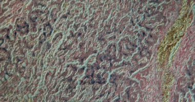 Hemosiderin dokuya sahip karaciğer mikroskop altında 100x büyütülmüş.