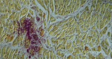 AIDS 'ten sonra kalp Candida mantarı ile enfekte oldu. Mikroskop altında 100 kat büyütüldü.