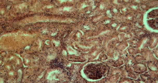 Veseszövet Tuberkulózisa Nagy Nagyításban Mikroszkóp Alatt 100X — Stock videók