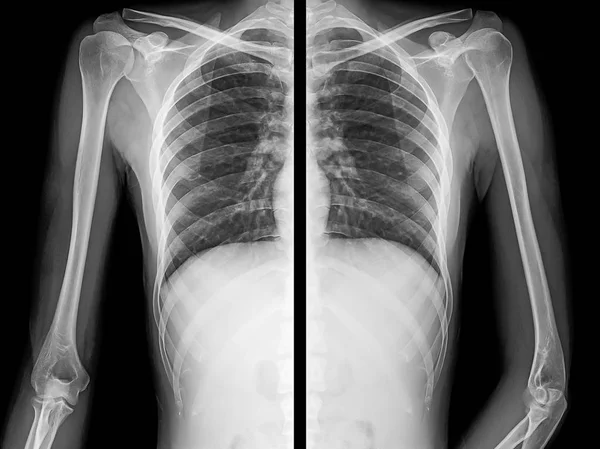 Ray Image Human Chest Arms Left Right Side — Stock Photo, Image