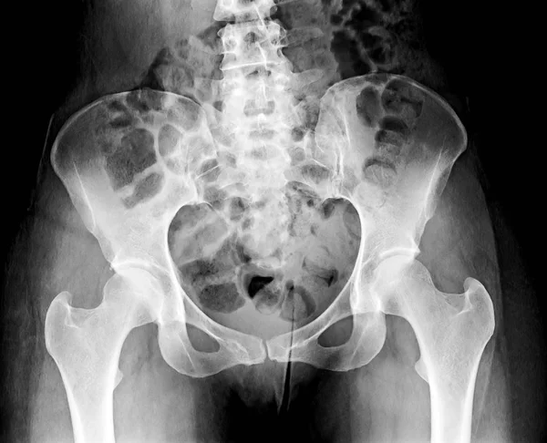 Pelvis Ray Human Skeleton Image — Stock Photo, Image