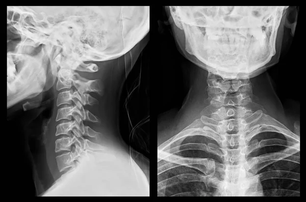 Ray Imaging Spinal Column Skull Head Lateral Posterior Views — Stock Photo, Image