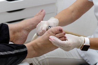 Profesyonel ayak hastalıkları uzmanı nasır ve cilt üzerinde mısır yetişkin kadın derisi..