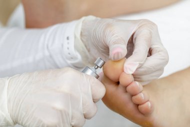 Ayak hastalıkları uzmanı, hastanın nasırlarını tedavi etmek için profesyonel bir cihaz kullanıyor. Kapatma işlemi