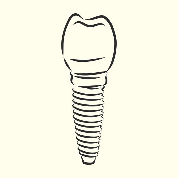 Vektör Çizimi Eskizler Diş Implantları Diş Implantı Vektör Çizimi — Stok Vektör
