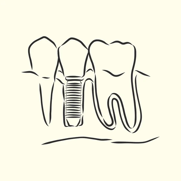 Vektorillustration Skizzen Zahnimplantate Vektor Skizze Für Zahnimplantate — Stockvektor