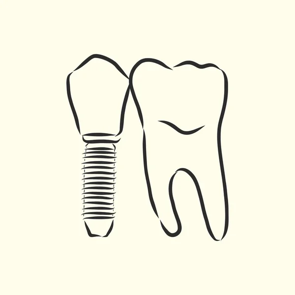 Vektör Çizimi Eskizler Diş Implantları Diş Implantı Vektör Çizimi — Stok Vektör