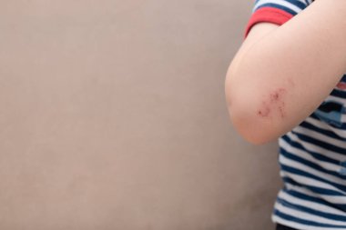Küçük bir çocuğun dirseği sıyrılmış. Yaralar, sıyrıklar, çocuk düşmesinden kaynaklanan çürükler. Çocuklar travmatik oyunlar oynar. Çocukluk konsepti. Çocuk bakımı konsepti. Kopyalama alanı olan pankart.