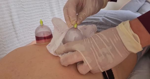 Vakuumtherapie Tasse Massage Vorhanden Traditionelle Hijama Behandlung Und Therapie Für — Stockvideo