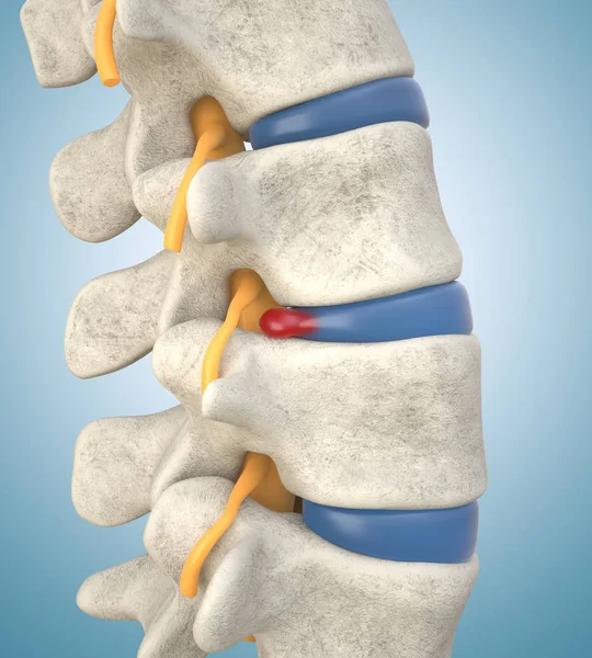 Human lumbar spine model with herniated disc — Stock Photo, Image