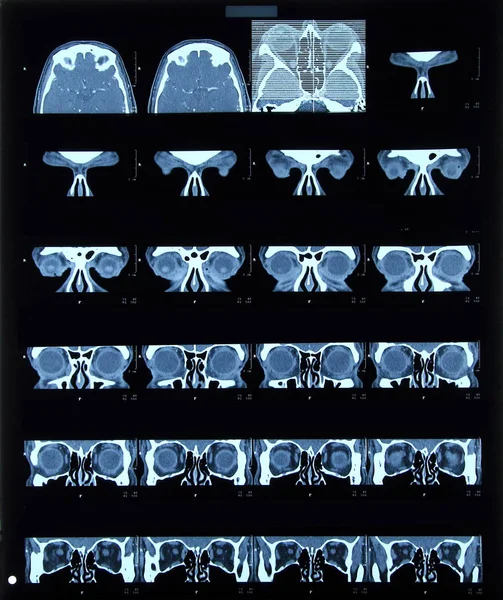 Röntgen Slice Huvudet Skalle — Stockfoto
