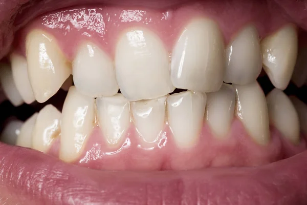Крупним планом знімок нерівномірних зубів людини з печивом . — стокове фото