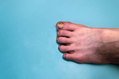 Mavi arka planda yakın plan mantar hastalığı olan çocuk ayağı.