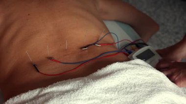 Therapist placing needles into a patient's back during an electroacupuncture session, using electric current for pain relief and stimulating specific points on the body for healing
