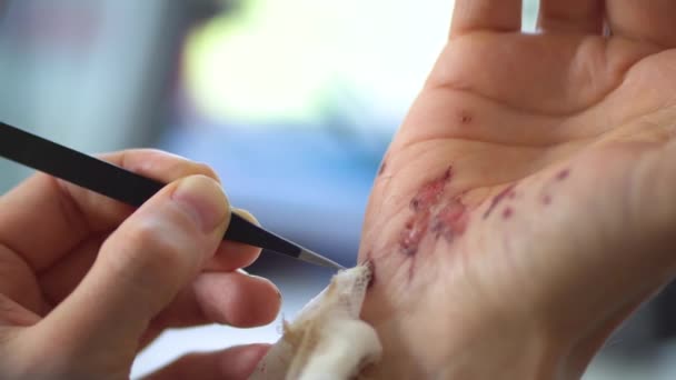 Egy férfi, aki vérző sebet tisztít a bőr alatt a baleset után. Mély sebek kezelése és fertőtlenítése. — Stock videók