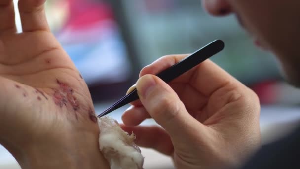 Man cleaning a bleeding wound under the skin after the accident. Treatment and disinfection of deep wounds. — Stock Video