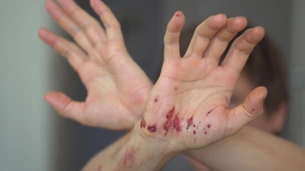 近距离观察一名男子在事故后皮肤下流血的伤口。深伤口的治疗和消毒. — 图库视频影像
