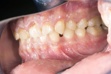 Overbite Dental Oklüzyon Closeup ile İnsan Çene Side View