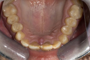 Üst İnsan Çenesi ve Damak Yakınlığı