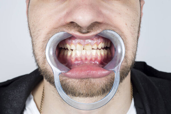 Разложение зубов и наращивание татар способствуют воспалению десен и обесцвечиванию зубов
