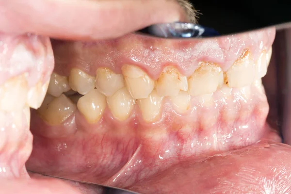 Caries Teeth Decay-Bad Teeth Care And Irregular Oral Hygiene Contribute To Buildup Of Plaque And Tartar On The Teeth