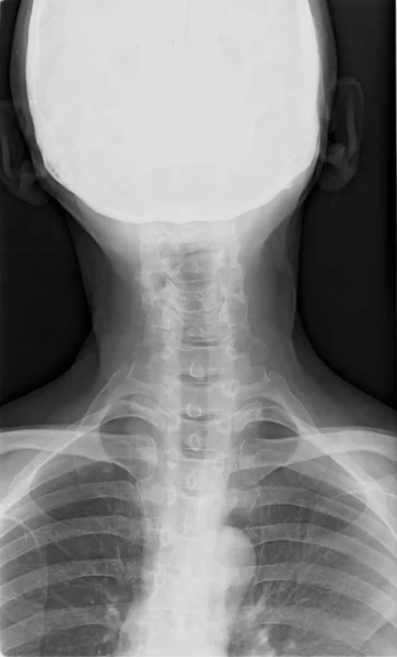 Radiografía de columna cervical —  Fotos de Stock