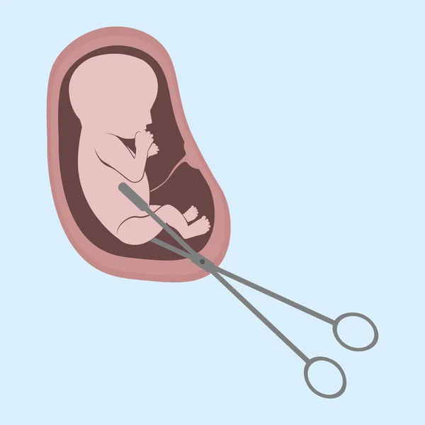 Ett Embryo Livmodern Och Kirurgisk Sax Abort Ett Personligt Beslut — Stock vektor