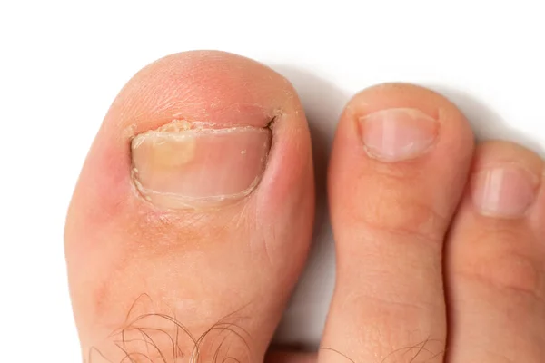 Toenail Fungus Big Toe Close — Stock Photo, Image