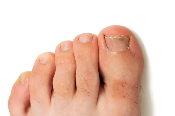 Toes Nail Fungus White Background — Stock Photo, Image