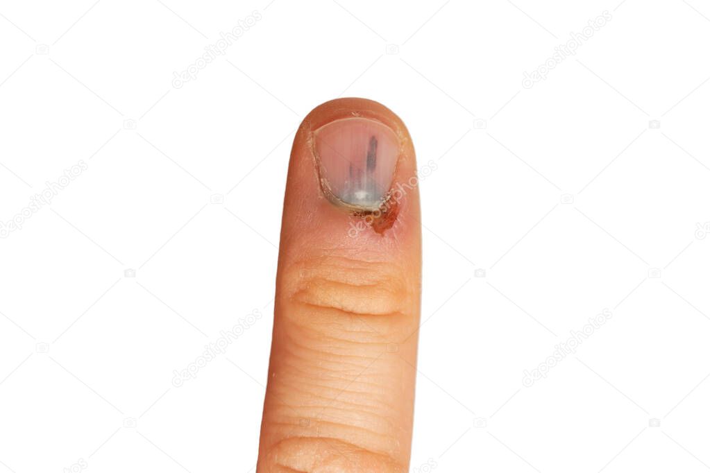 injured nail, close-up. Blackened nail