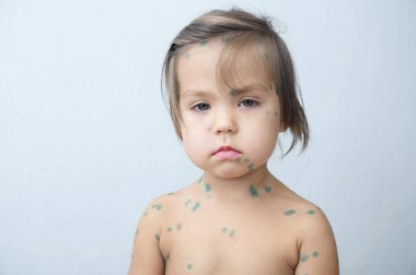 Su çiçeği ile çocuk portre. Deri Erüpsiyonu yapma varicells ile hasta küçük kız. Dokunulmazlık sonsuza dek sahip uzun ev karantina.