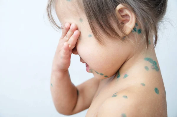 Kind Met Waterpokken Ziek Meisje Met Varicells Maken Van Uitbarsting — Stockfoto