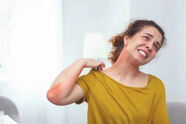 Adolescent lady tourist suffering from a sunburn — Stock Photo, Image