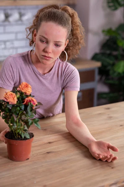 Irriterad ljus-haired girl har extrema allergisk reaktion — Stockfoto