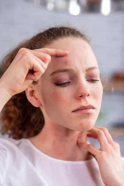 Miserable dama de pelo largo que tiene problemas con la piel — Foto de Stock