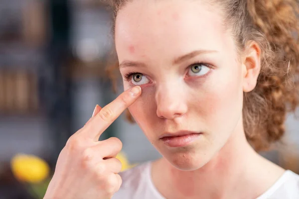 Unfortunate young lady with curly hair itching her eyelid — Stock Photo, Image