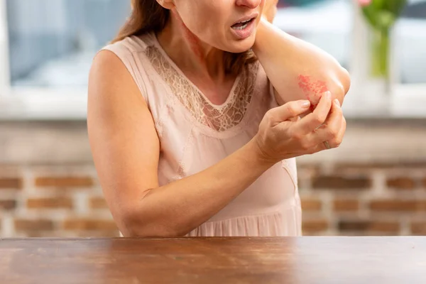 Mogen hemmafru står nära bordet och ha utslag på armbågen — Stockfoto