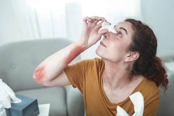 Mujer rizada con enrojecimiento en el brazo usando gotas para los ojos — Foto de Stock